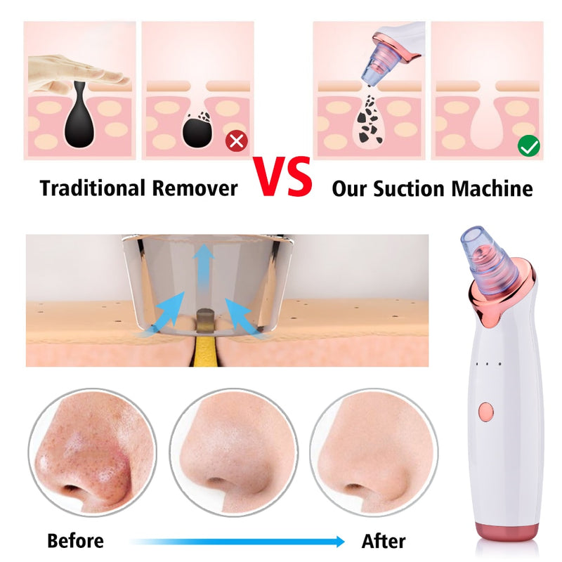 Facial Blackhead Remover